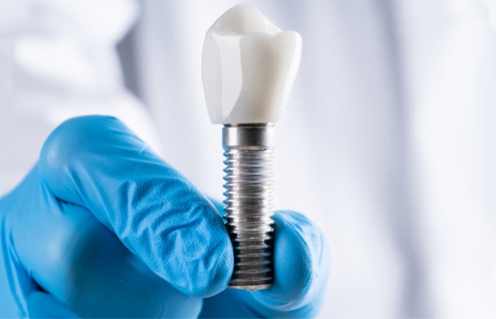 Dental Implant Full Mouth